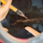 hair transplant di Indonesia vs luar negeri